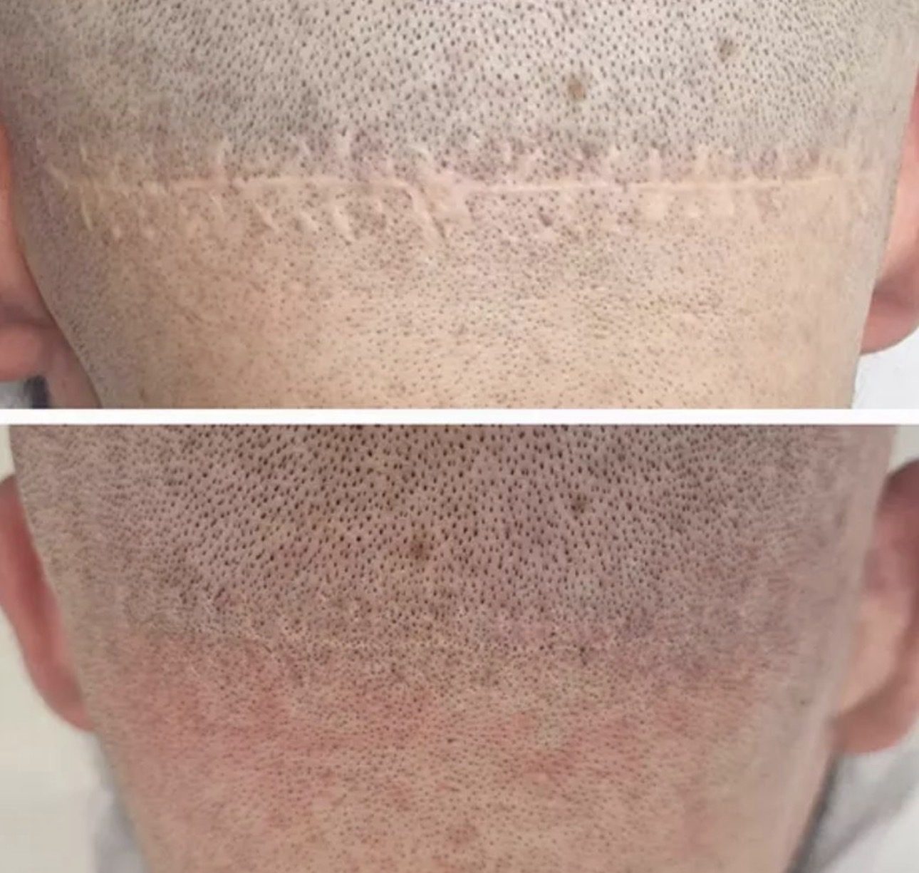 Prima e dopo autentico della copertura di una cicatrice nucale con tricopigmentazione