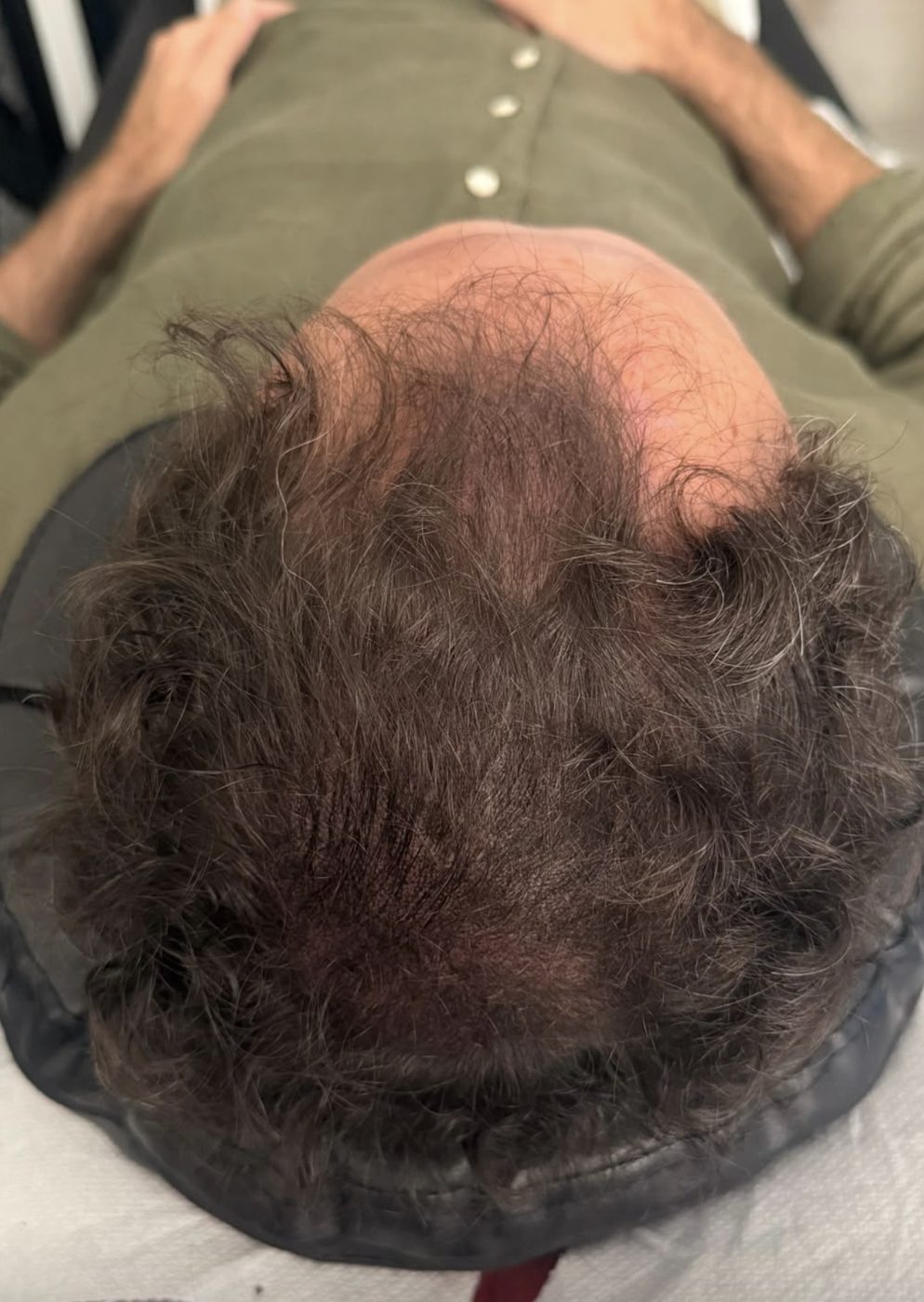 Cuoio capelluto visto dall’alto dopo un trattamento autentico di infoltimento con tricopigmentazione