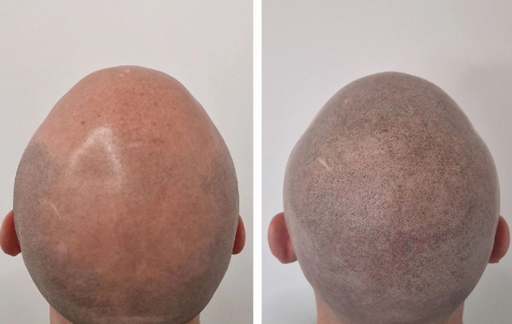 Prima e dopo autentico di una tricopigmentazione effetto rasato, testa vista da dietro