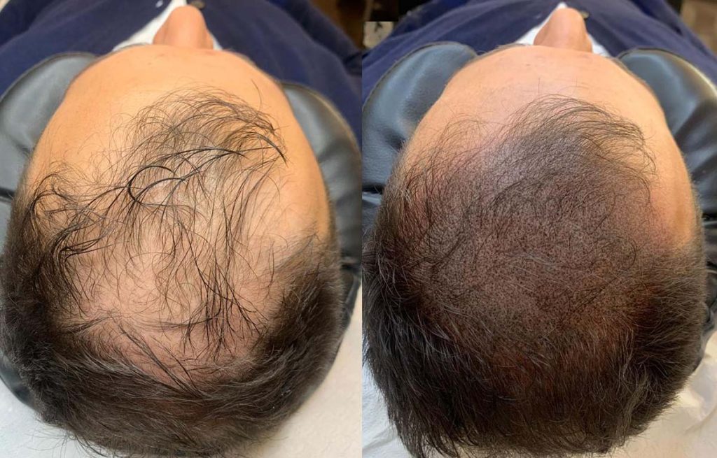 tricopigmentazione-rinfoltimento-capelli-zona-nucale-new-4