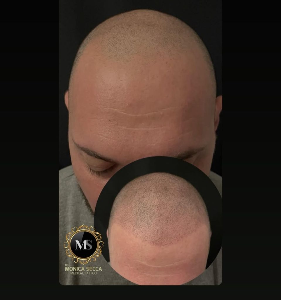 tricopigmentazione capelli uomo