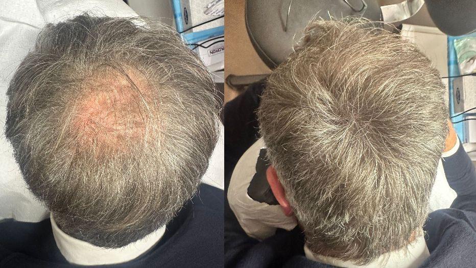 trico_effetto_densita_infoltimento_uomo