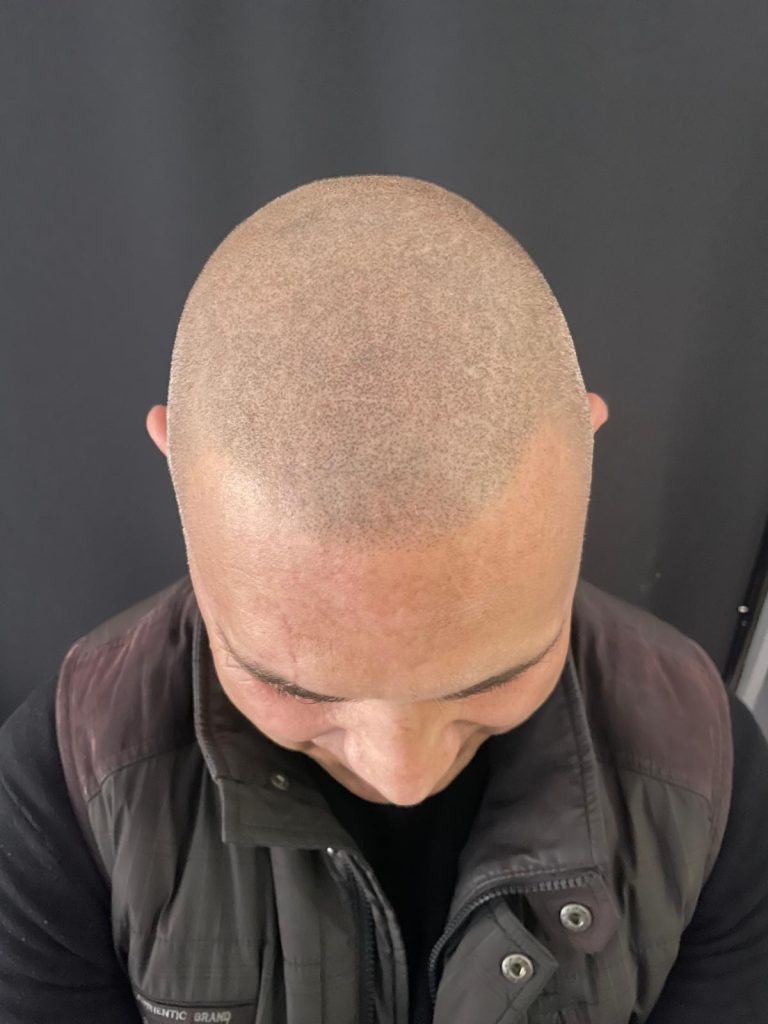trico_effetto_rasato_guarita_dopo_6_mesi